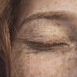 melasma en el embarazo